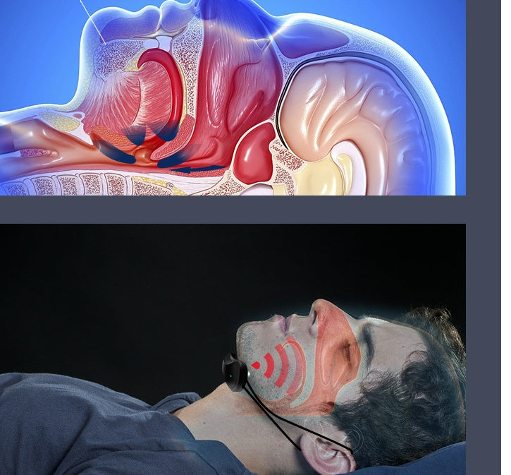 Intelligent Anti-snoring Device Anti-snoring Magic Health Device