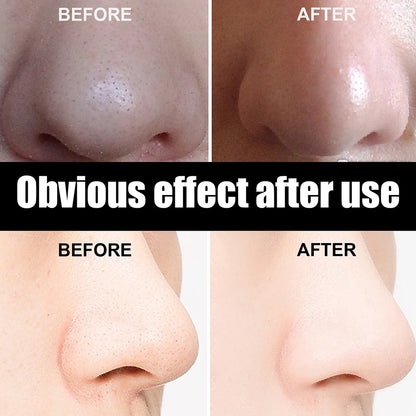 Peel Off Blackheads Remove Plaster Nose Strips Pull Black Mask for Women Beauty